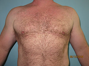 Male Breast Reduction - Gynecomastia