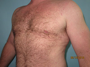 Male Breast Reduction - Gynecomastia