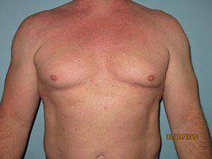 Male Breast Reduction - Gynecomastia