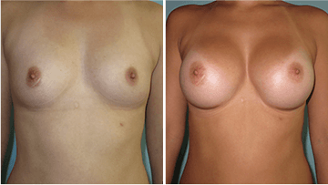 Breast Augmentation Surgery Results Scottsdale