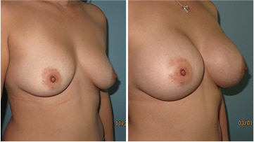 Breast Augmentation Surgery Before After Scottsdale