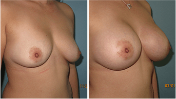 Breast Augmentation Surgery Results Scottsdale