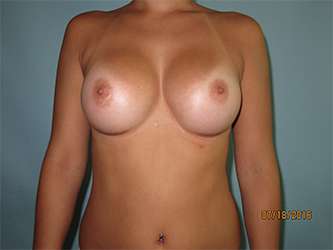 Breast Augmentation After - Breast Procedures Scottsdale