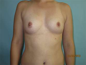 Breast Augmentation Before - Breast Procedures Scottsdale