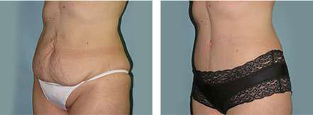 abdominoplasty procedure results Scottsdale, AZ
