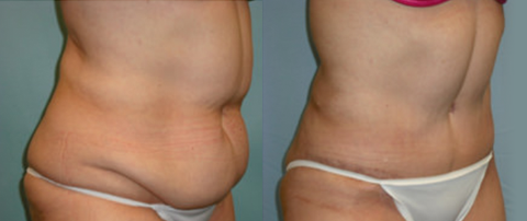 tummy tuck surgery before after Scottsdale, AZ