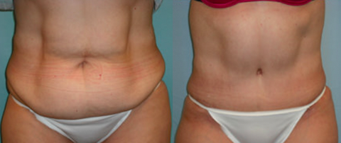 Ultimate Tummy Tuck Recovery Guide for Scottsdale
