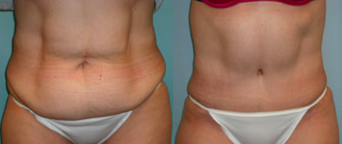 abdominoplasty surgery before after Scottsdale, AZ