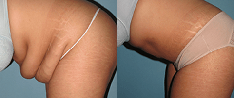 tummy tuck surgery results Scottsdale, AZ
