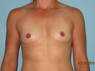 Breast Augmentation Before Surgery Photo Scottsdale 