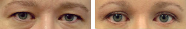 Before and After Image of Forehead Lift Scottsdale