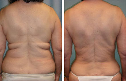 vaser liposuction before after Scottsdale, AZ