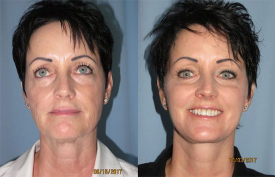 Before and After Image of Facelift Scottsdale AZ