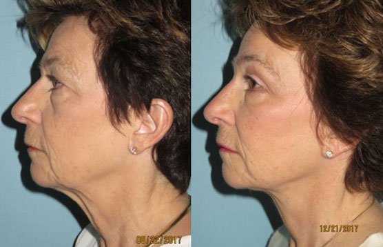 Before and After Image of Mini Facelift Phoenix AZ