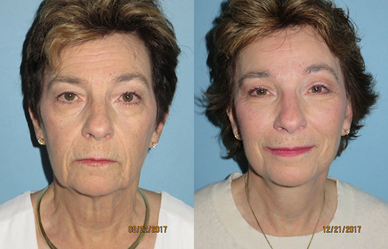 Before and After Image of Facelift Glendale AZ
