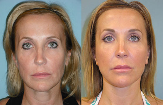 Before and After Image of Facelift Phoenix AZ