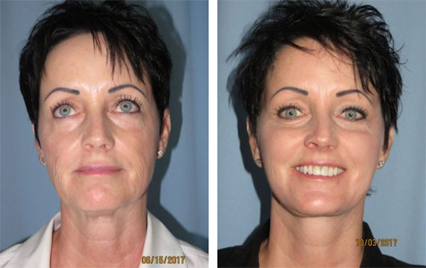 facelift treatment before after Scottsdale, AZ