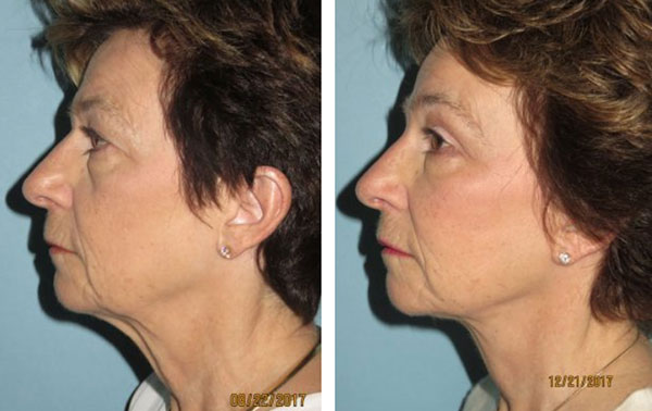 facelift results Phoenix, AZ