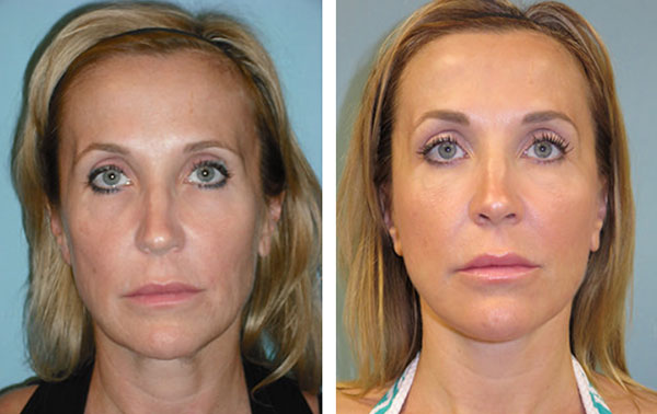 facelift treatment results Phoenix, AZ