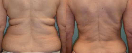 liposuction before after Scottsdale, AZ