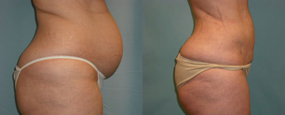 liposuction procedure results Scottsdale, AZ
