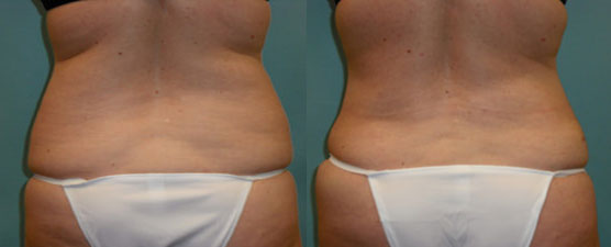 liposuction surgery results Scottsdale, AZ