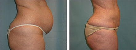 vaser liposuction results Scottsdale, AZ