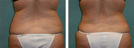 vaser liposuction surgery result photos Scottsdale, AZ