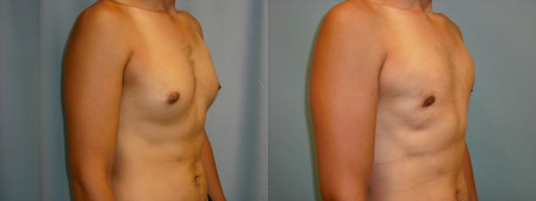 Before & After Image of Gynecomastia Surgery Scottsdale