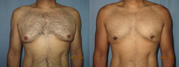 Before & After Image of Male Breast Reduction Phoenix