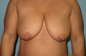 Breast Lift (Mastopexy)