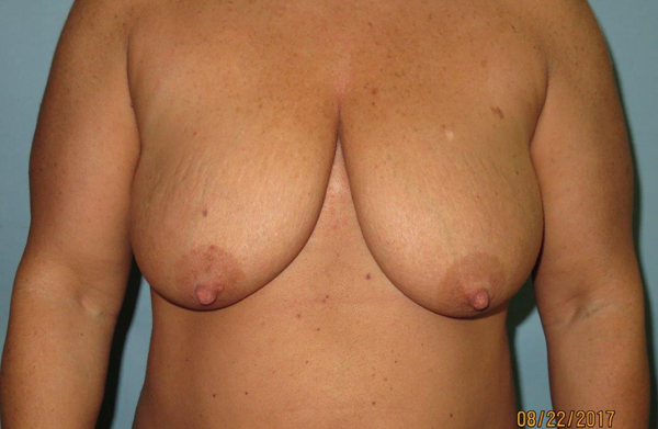 Breast Lift (Mastopexy) Before