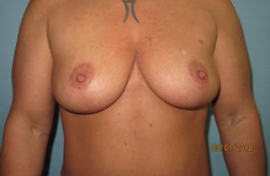 Breast Lift (Mastopexy)