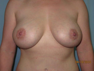 Breast Lift (Mastopexy)