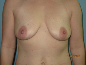 Breast Lift (Mastopexy)