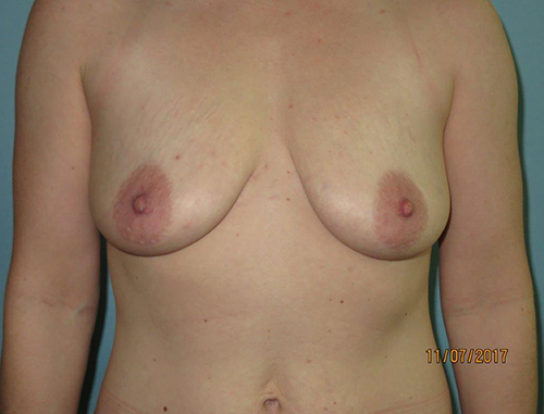 Breast Lift (Mastopexy)