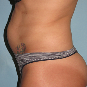 Tummy Tuck