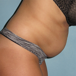 Tummy Tuck