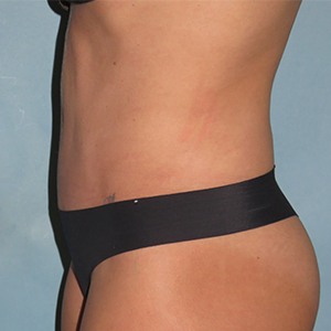 Tummy Tuck