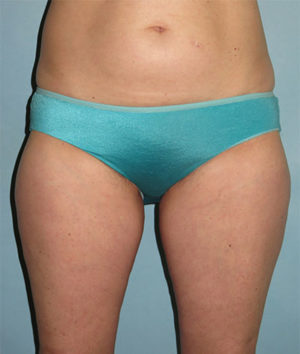 Liposuction