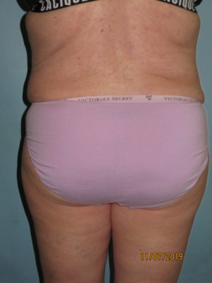 Liposuction