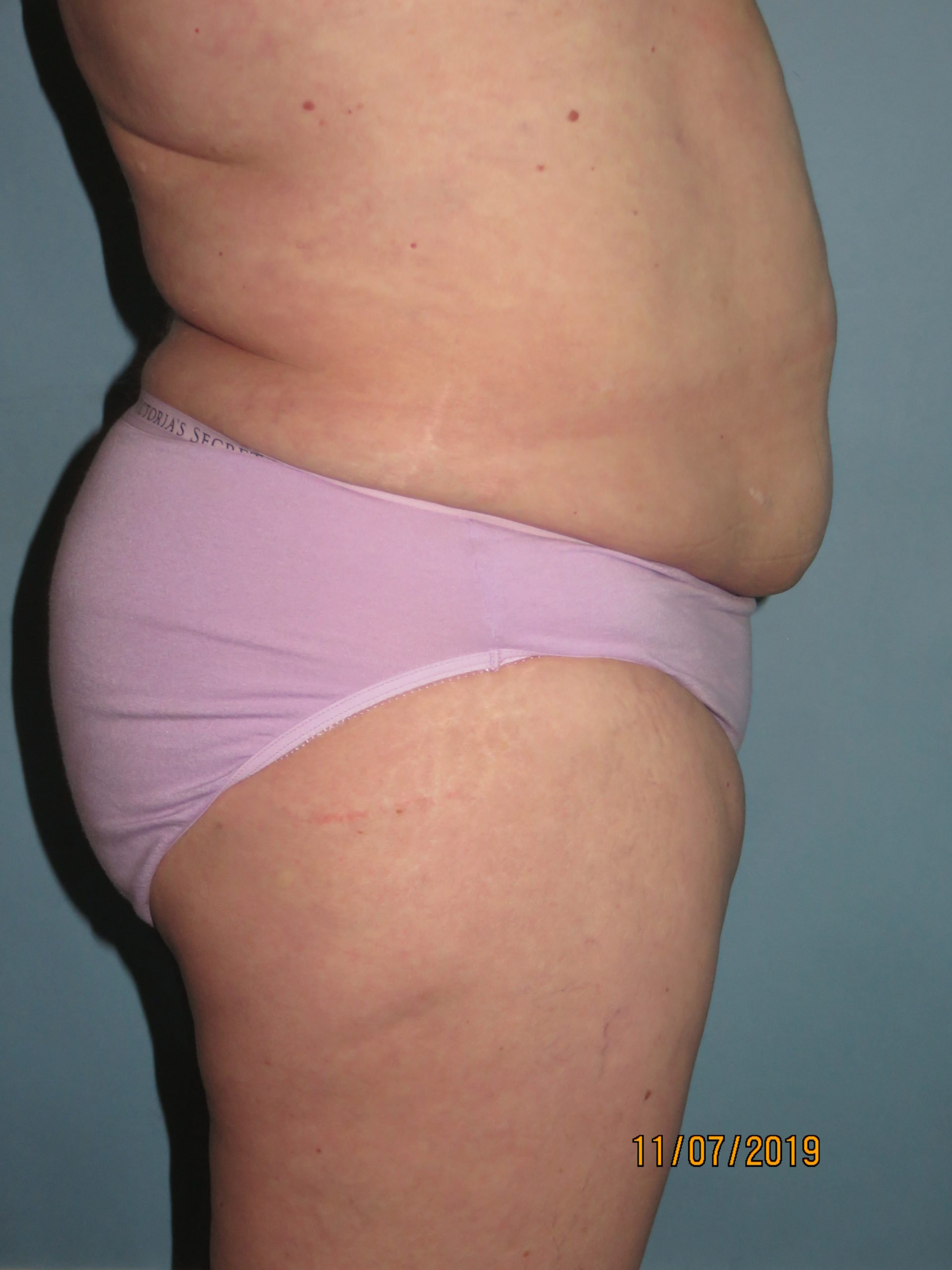 Liposuction