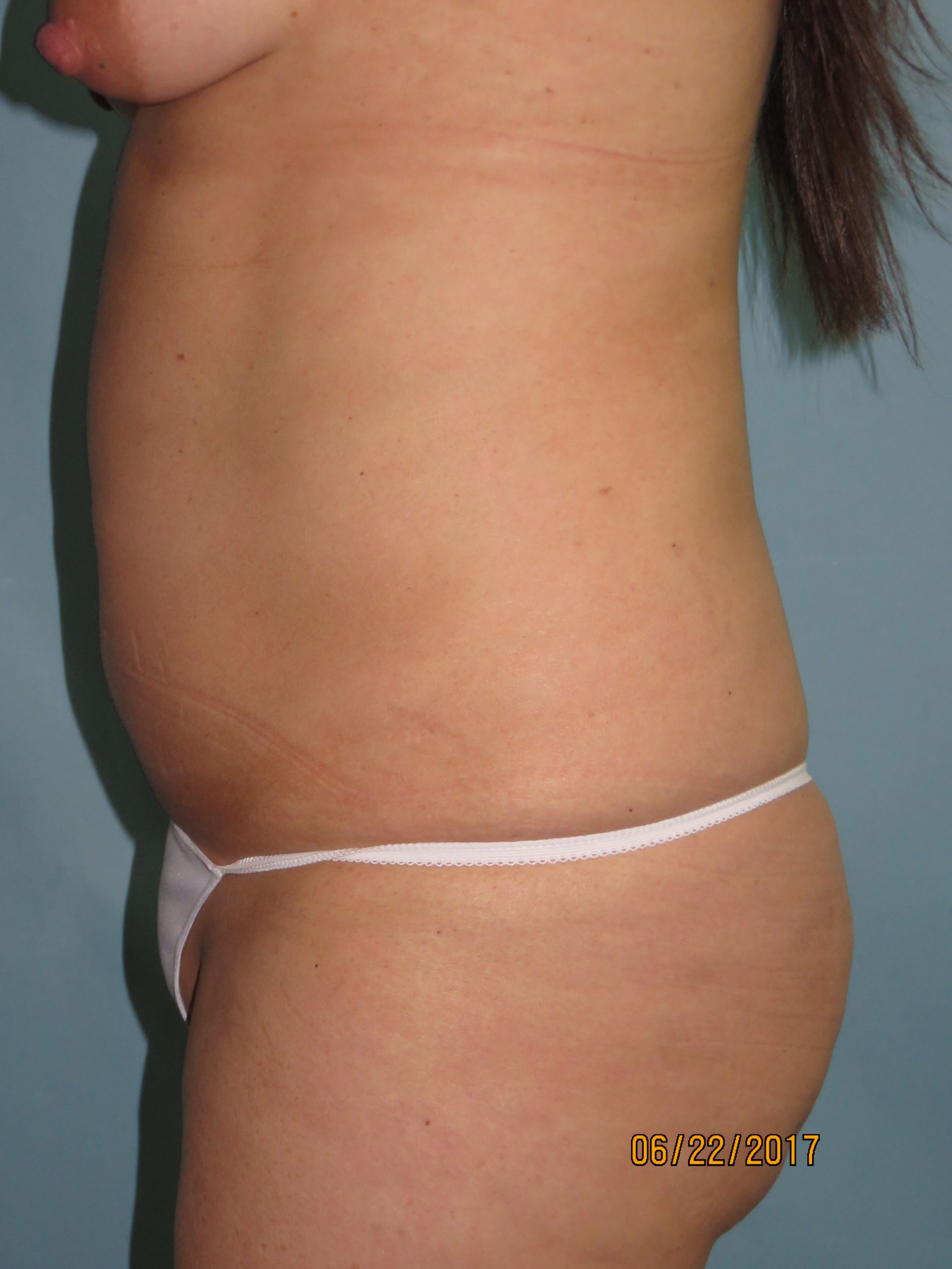 Liposuction