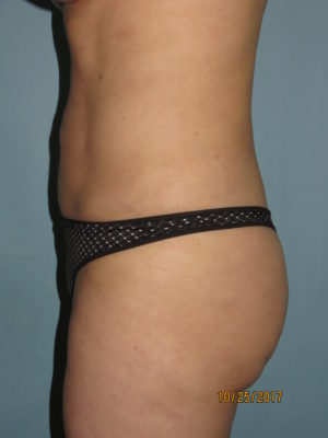 Liposuction