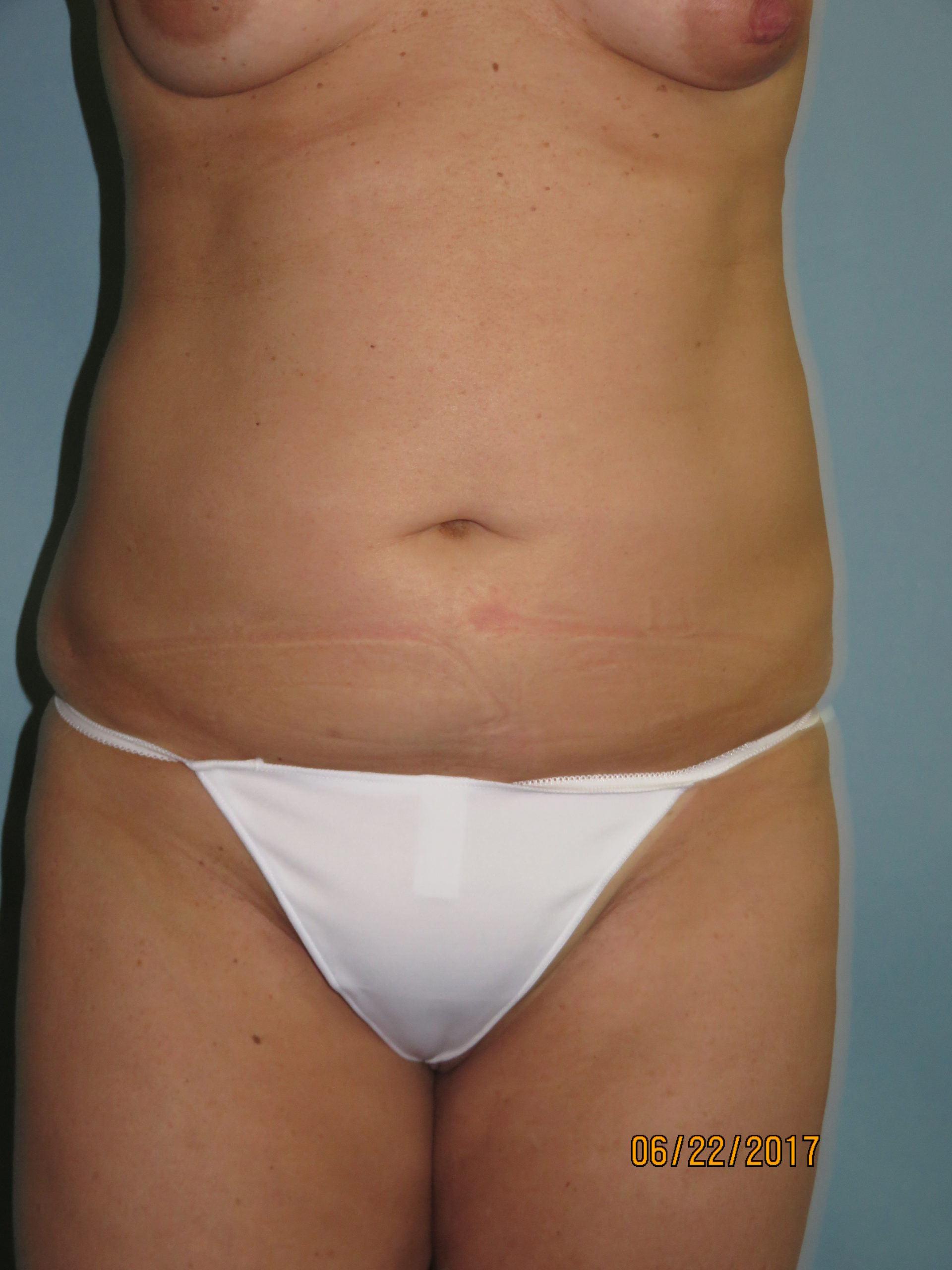 Liposuction