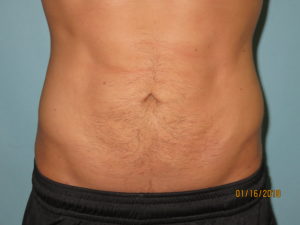 Liposuction