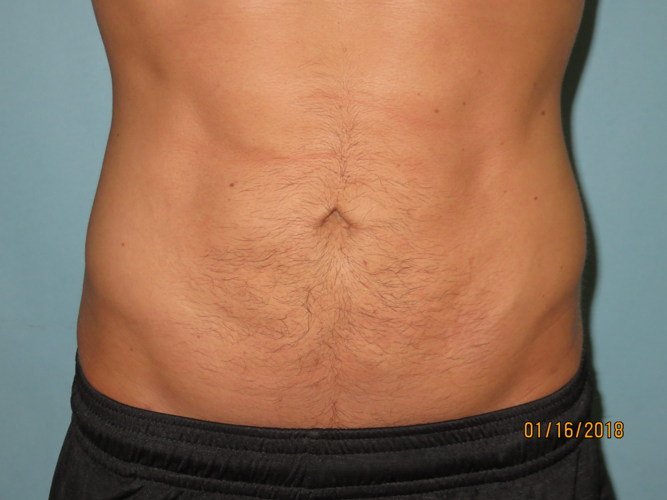 Liposuction