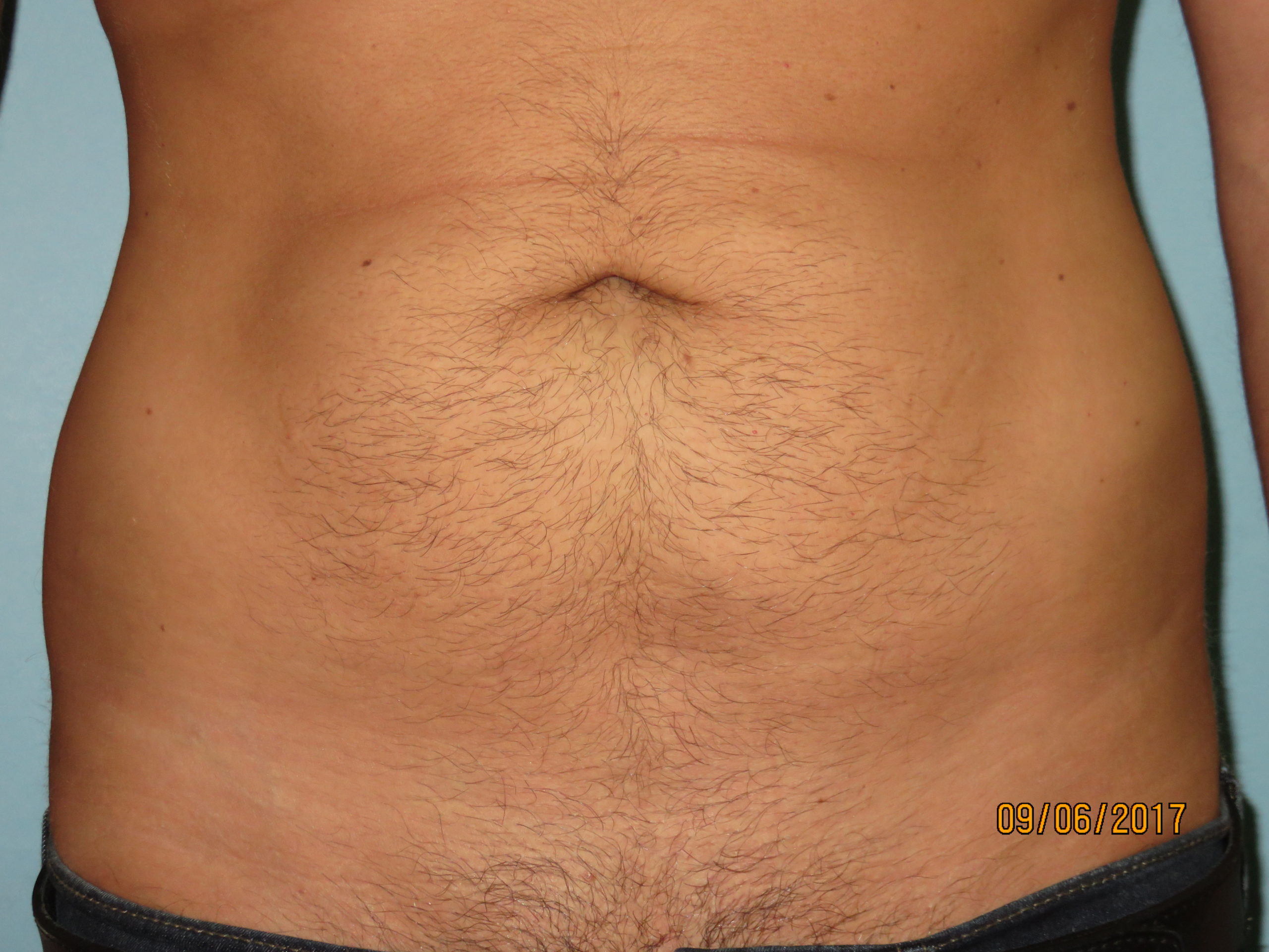 Liposuction