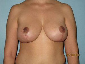 Breast Reduction