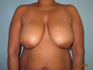 Breast Reduction